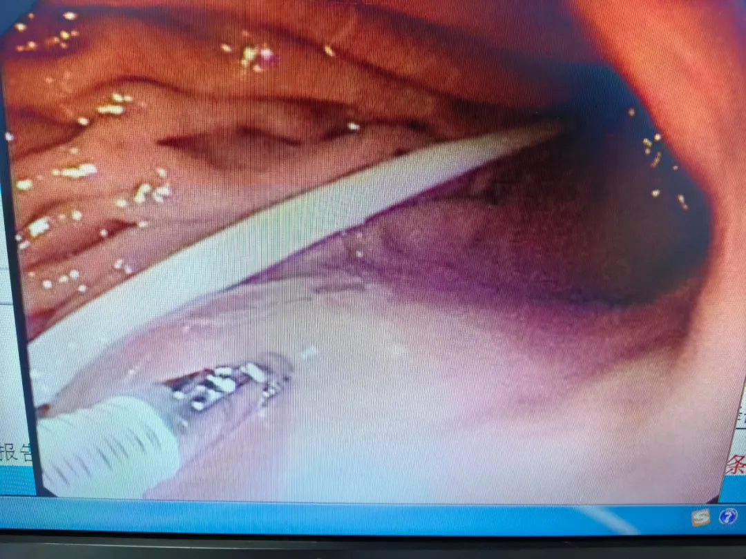 Painless gastroscopy in progress at Beijing Jingdu Children's Hospital