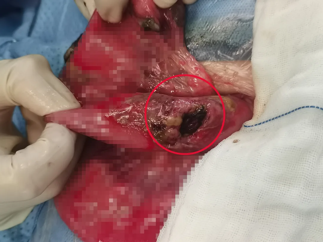Emergency repair of a child's jejunal perforation after a seesaw accident
